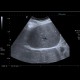 Arteriovenous malformation of liver, AV malformation: US - Ultrasound